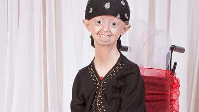 A los 17 años, murió la adolescente que envejeció antes de tiempo | Actualidad