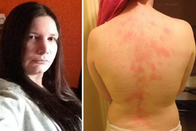 Conocé a la mujer que es alérgica al agua, sudor, lágrimas y besos | Curiosidades