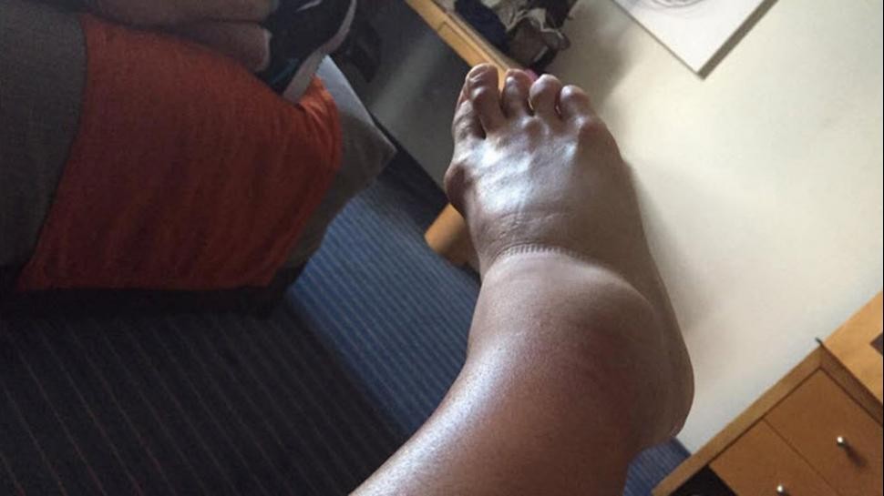 Como Diego en el Mundial 90: así estaba el tobillo de un argentino que juega en México | Deportes