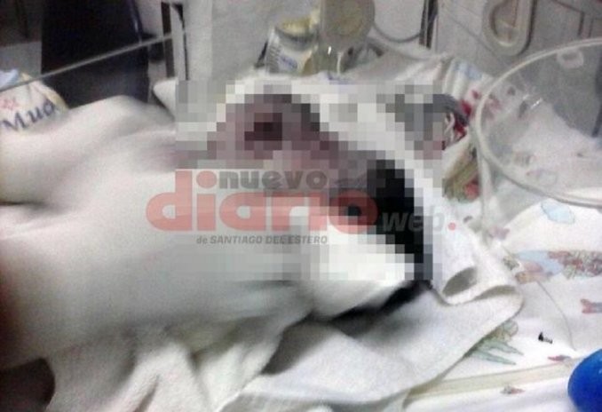 Conmoción en Santiago del Estero por el nacimiento de un bebé con dos cabezas | Actualidad