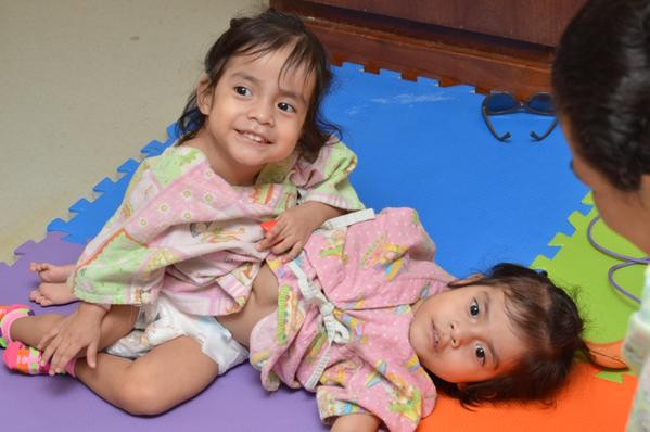 Separaron exitosamente a las "Rositas" las niñas siamesas abandonadas en un hospital de Guatemala | Internacionales