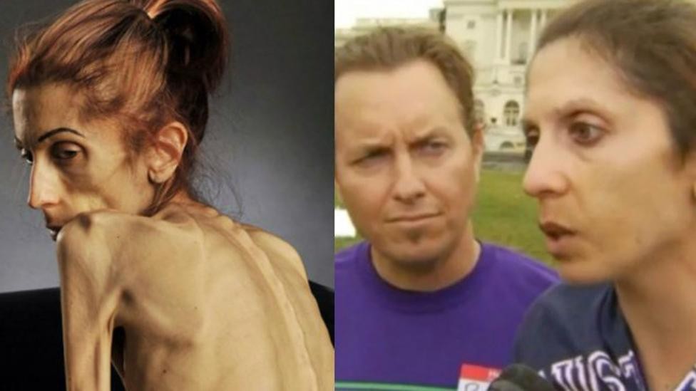 La mujer que pidió ayuda por Internet y se recuperó de la anorexia | Curiosidades