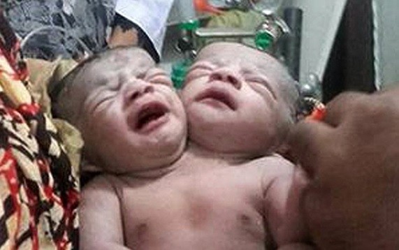 Bangladesh: conmoción por el nacimiento de una bebé con dos cabezas | Curiosidades