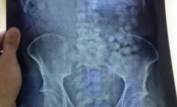 Uruguay: Detuvieron a un ciudadano holandés con más de un kilo de cocaína en el estómago | Internacionales