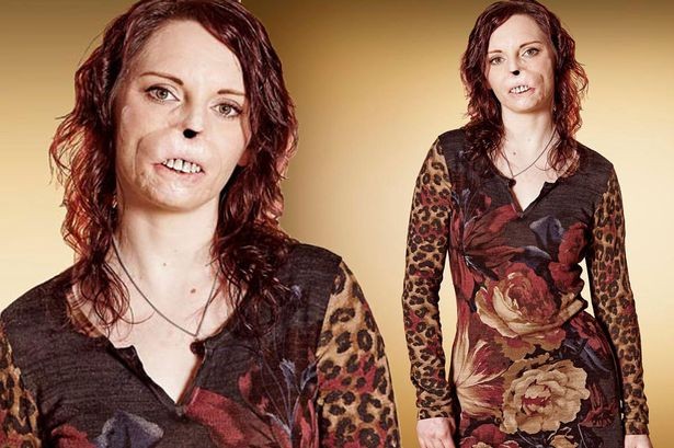 Mujer que perdió su nariz tras meningitis participará en un polémico show televisivo de citas | Espectáculos