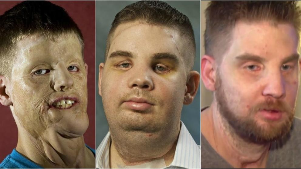 La nueva vida de un trasplantado de cara | Curiosidades