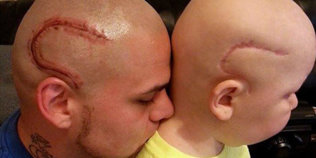 Amor de padre: se tatuó la misma cicatriz que su hijo operado de cáncer | Internacionales