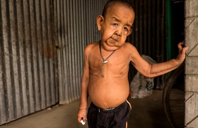 Bangladesh: la historia del nene que tiene 4 años pero parece una persona de 80 | Internacionales