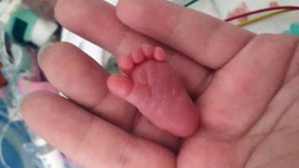 La historia de la bebé más chica del mundo | Curiosidades