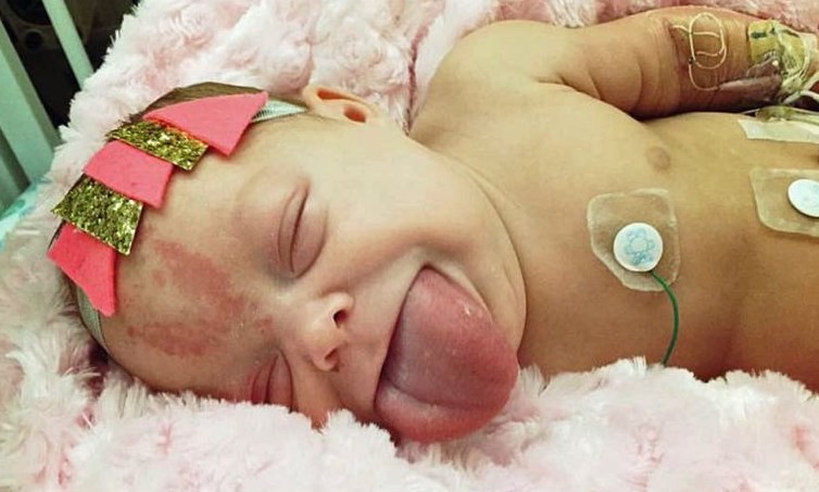 El increíble caso de la bebé que nació con la lengua de un adulto | Curiosidades
