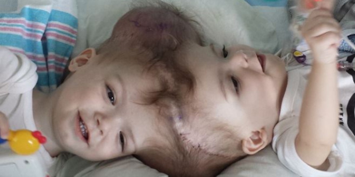 El emocionante momento en que dos siameses separados se ven por primera vez | Internacionales