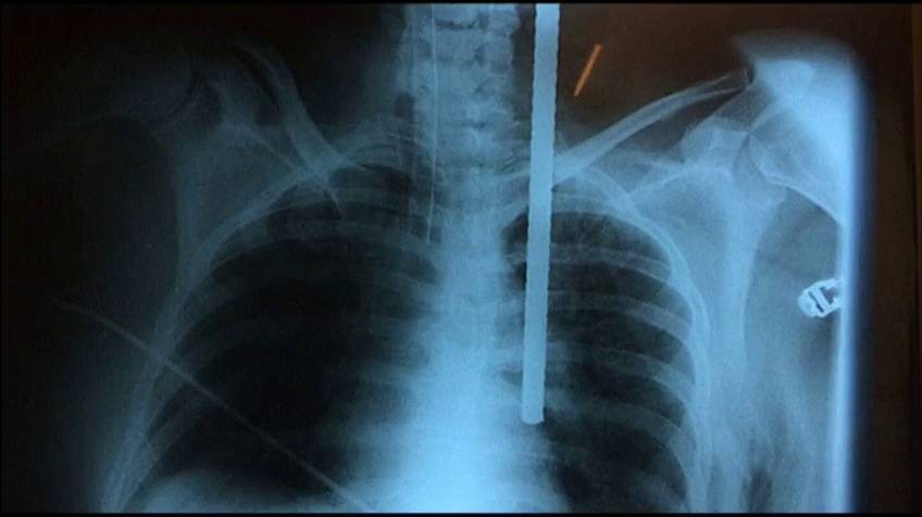 Por salvar a su nieta, cayó de una terraza y se clavó un hierro | Internacionales