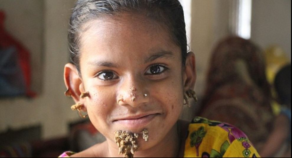 Dramático: a una nena de 10 años  diagnosticaron la "enfermedad del hombre árbol" | Internacionales