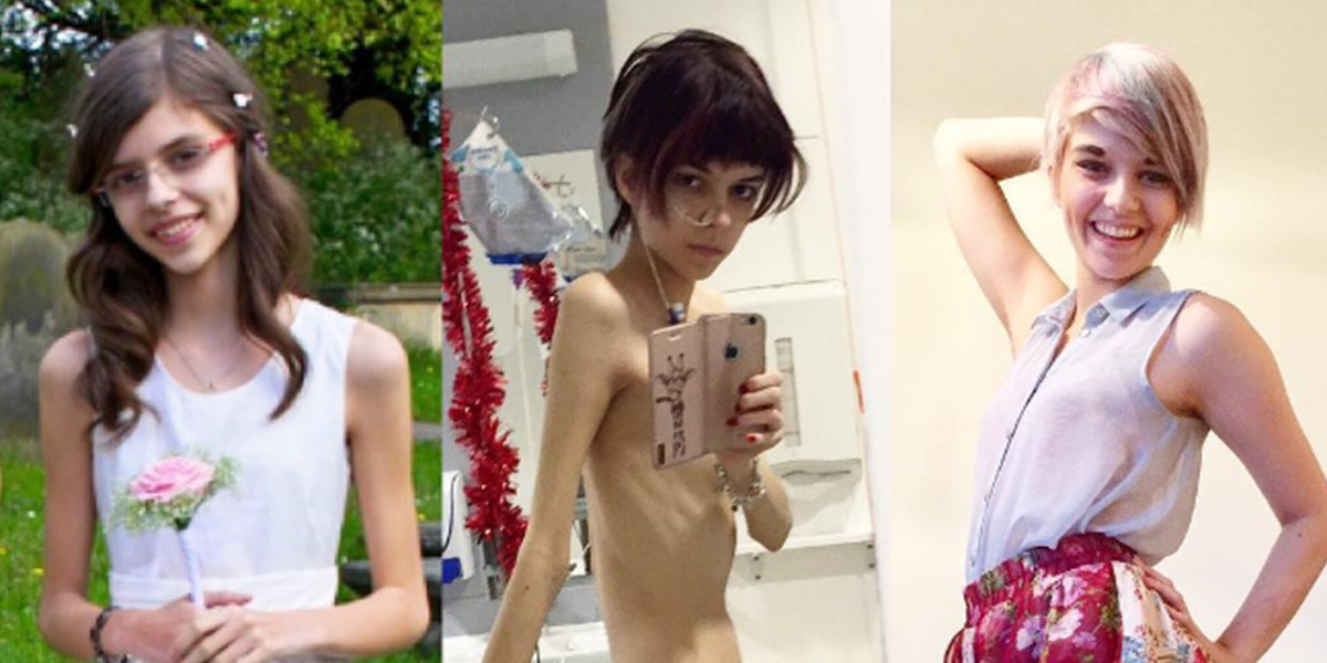 La inspiradora historia de la joven que mostró en fotos cómo superó la anorexia | Redes