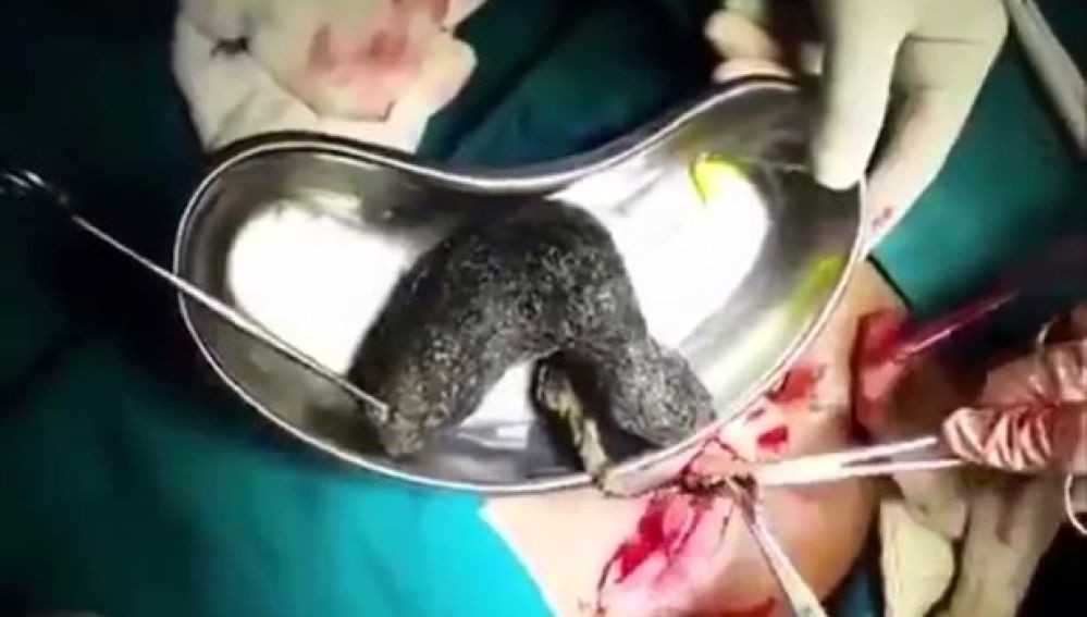 La increíble bola de pelo que sacaron del estómago de un paciente | Curiosidades
