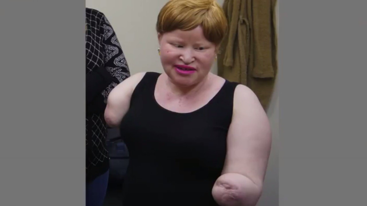 Tanzania: La historia de la mujer albina a la que le cortaron las manos para hacer una poción mágica | Curiosidades