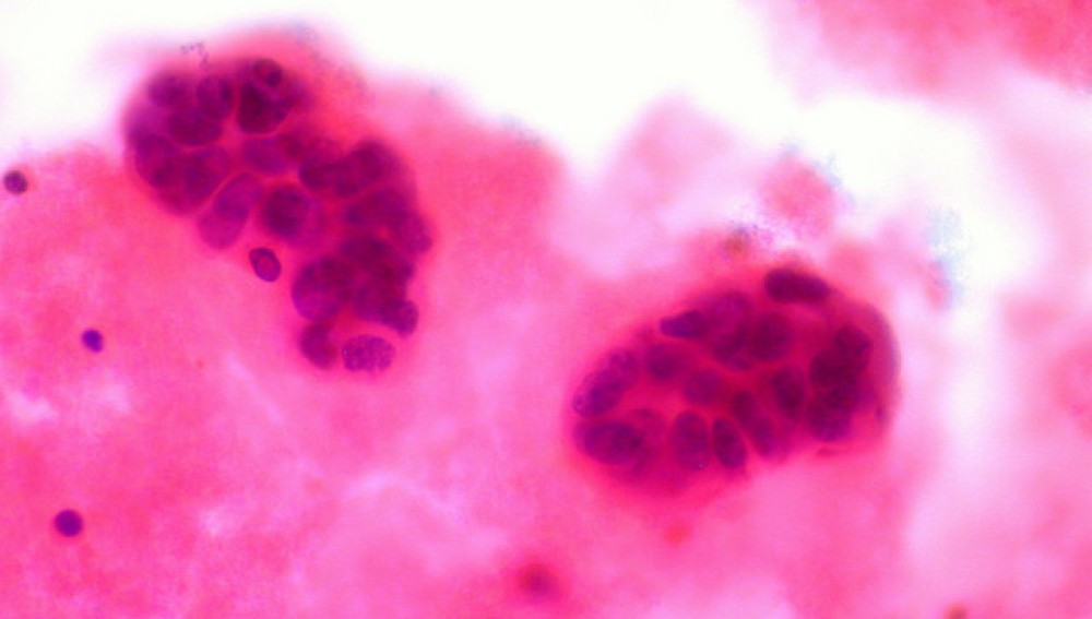 Descubrieron una técnica para detener la metástasis en enfermos de cáncer | Internacionales