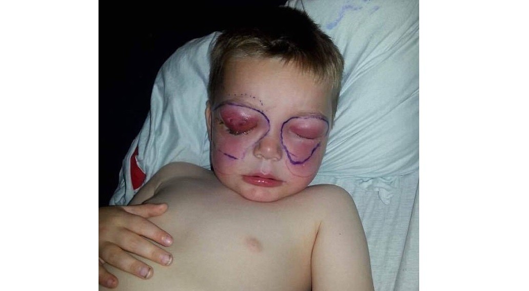 Un niño de cuatro años casi muere en horas al infectarse con la bacteria "come carne" | Internacionales