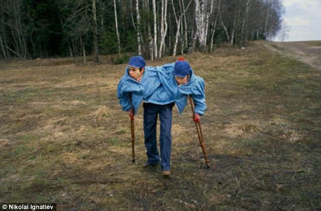 La increíble historia de las siamesas soviéticas que vivieron unidas hasta los 53 años | Curiosidades