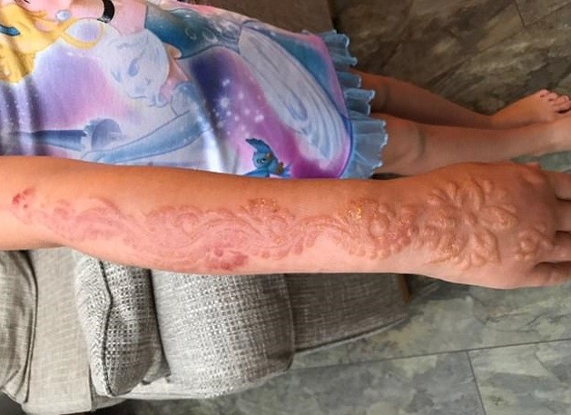 Nena de 7 años sufrió graves quemaduras al realizarse un tatuaje de henna | Internacionales