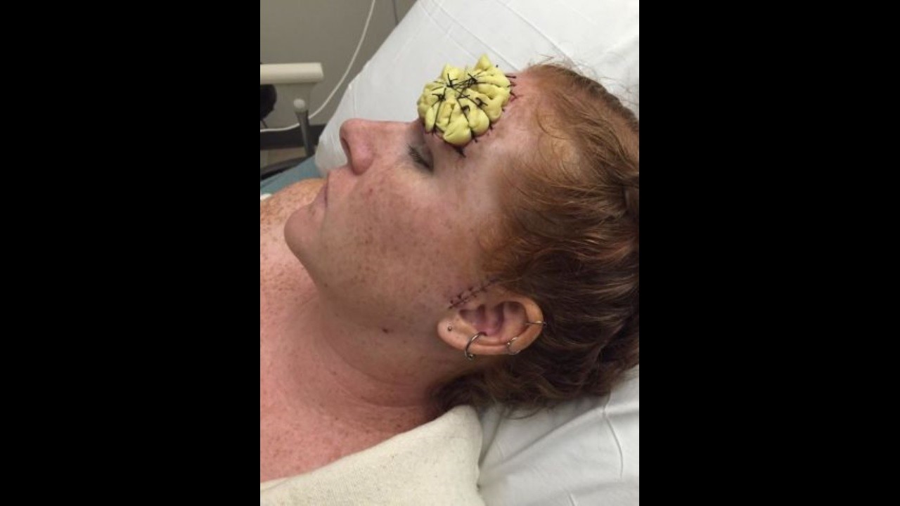 "Dejen de tomar sol": la dura de batalla de una mujer contra el cáncer de piel | Redes