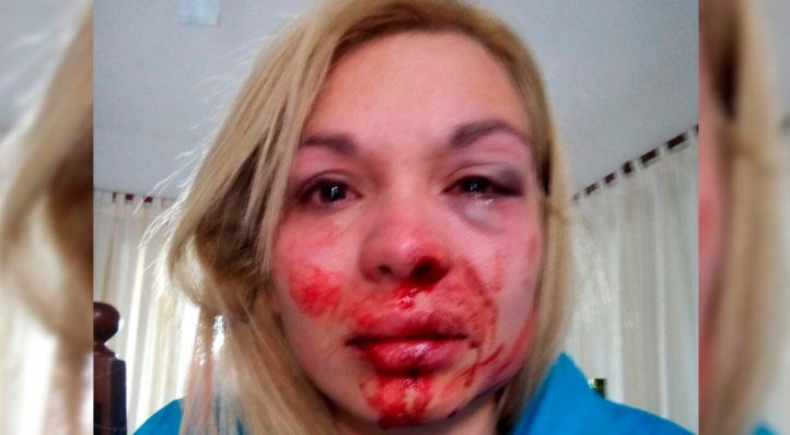 Una personal trainer sufrió una brutal golpiza de su pareja: "Me quiso tirar por las escaleras" | Actualidad