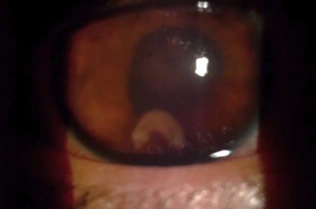 Impresionante: Le molestaba el ojo y descubrieron que tenía un gusano que se lo estaba comiendo | Curiosidades