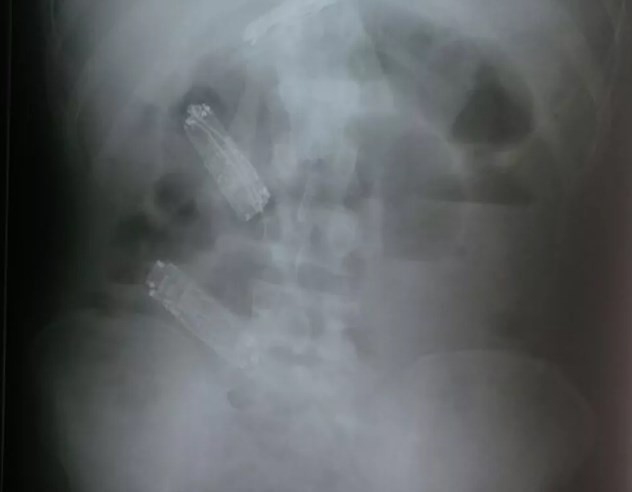 Brasil: un preso se tragó tres celulares y murió una semana después | Internacionales