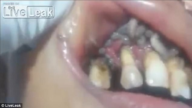 Video escalofriante: el momento en que un dentista se enfrenta a una boca repleta de gusanos | Curiosidades