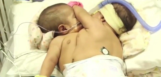 Separaron con éxito a las “Esmeraldas” guatemaltecas, dos siamesas que nacieron unidas por el pecho | Internacionales