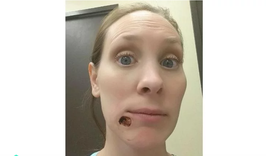 Pensó que era un grano, pero se trataba de un cáncer de piel que le dejó un agujero en la cara | Internacionales