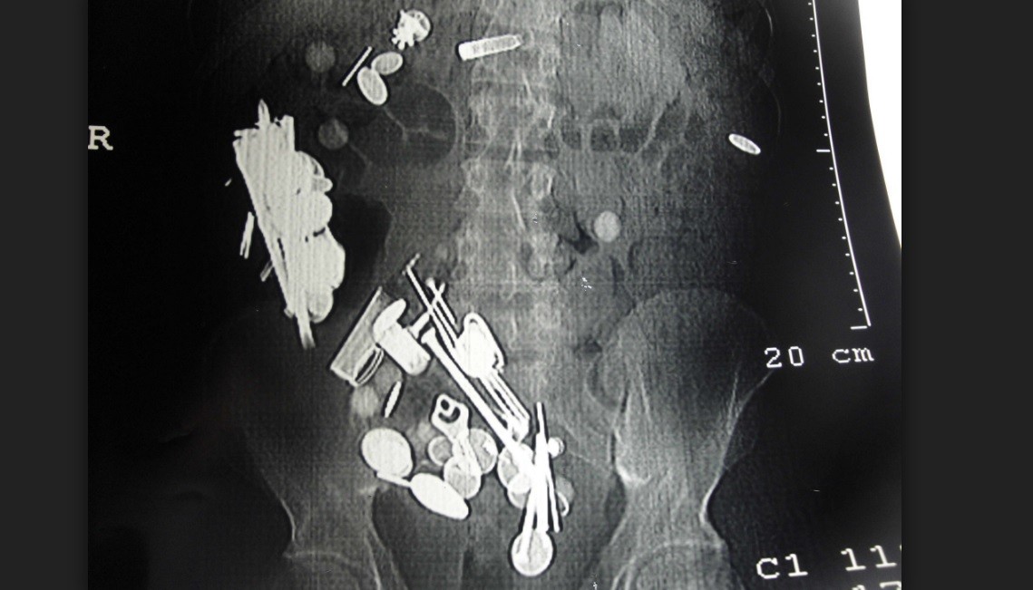 El extraño caso del hombre con depresión que se comió 263 monedas, 150 clavos y una correa para perros | Curiosidades