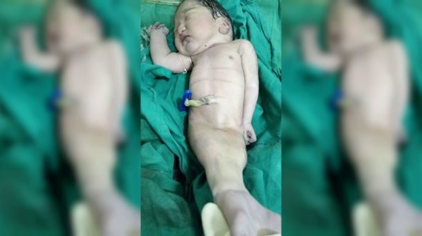 Nació un "bebé sirenita en la India, pero sólo sobrevivió unas horas | Internacionales
