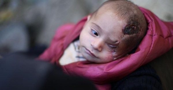 La historia de Karim, el bebé sirio que perdió un ojo y se convirtió en símbolo de la resistencia | Internacionales