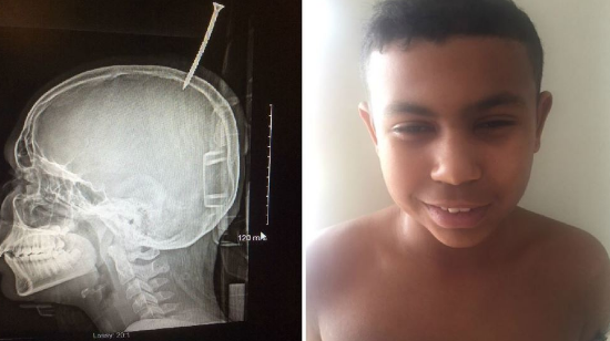 Un adolescente sobrevivió después de que un tornillo de 15 centímetros le perforara el cráneo | Internacionales
