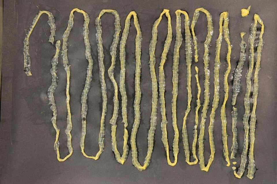Singapur: el paciente que se sorprendió al ver la lombriz parásito que sacaron de su intestino | Curiosidades