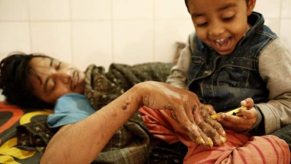 La historia del paciente que tiene pánico de volver a convertirse en el "hombre árbol" | Internacionales