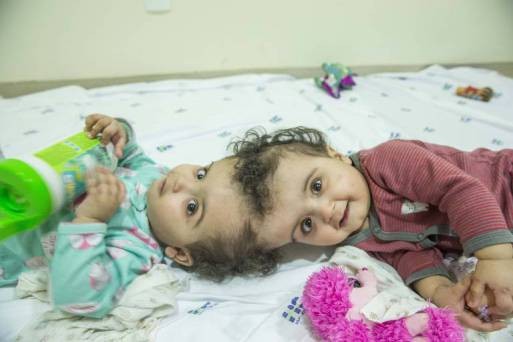 Lograron operar con éxito a las siamesas brasileñas María Ysabelle y María Ysadora | Internacionales