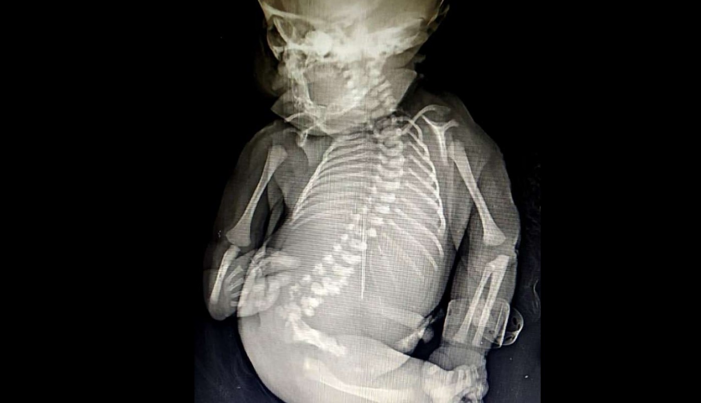 Una mujer dio a luz a un "bebé sirena" que sólo vivió quince minutos | Internacionales