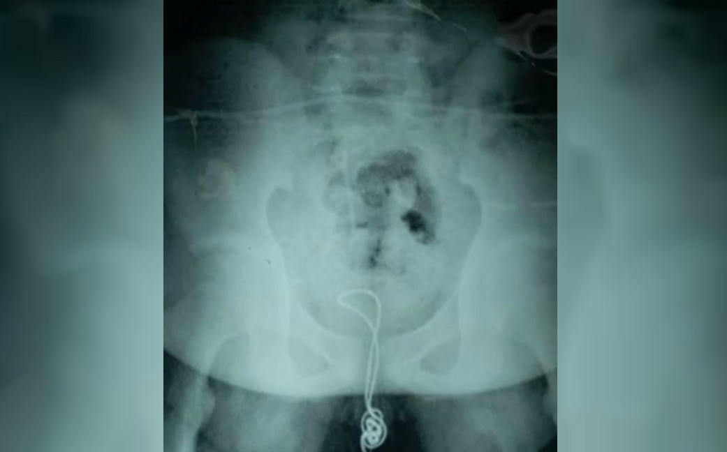 Un joven chino se metió un cable USB por el pene y tuvo que ser operado | Curiosidades