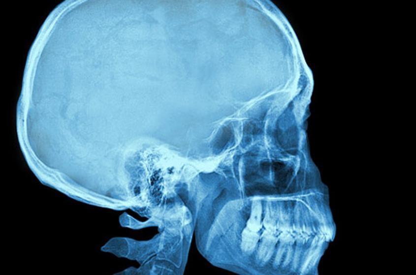 Hallan 100 huevos de un parásito en el cerebro de una nena que sufría dolores de cabeza | Curiosidades