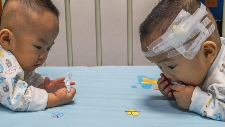 Una pareja china tenía que elegir uno solo de sus mellizos para que siga vivo hasta que llegó la solución | Internacionales