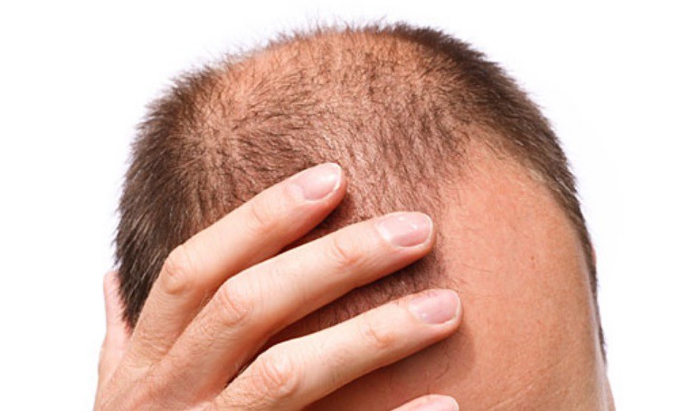 Testean con éxito un compuesto que revierte la caída del pelo | Internacionales