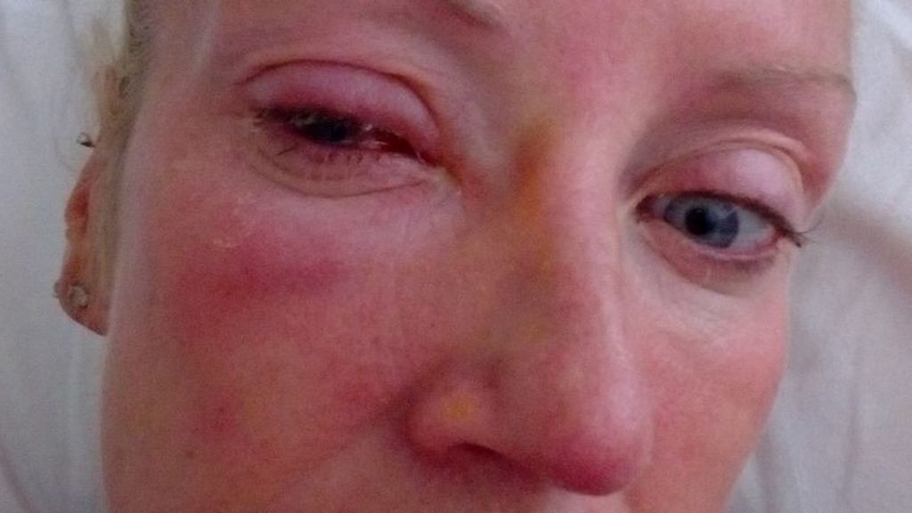 Un parásito se pegó en su lente de contacto, le comió el ojo y la dejó ciega | Internacionales