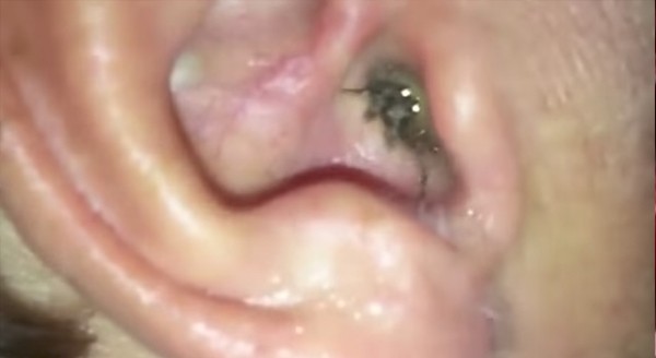 Descubrimiento escalofriante: tenía una araña en el interior del oído | Curiosidades