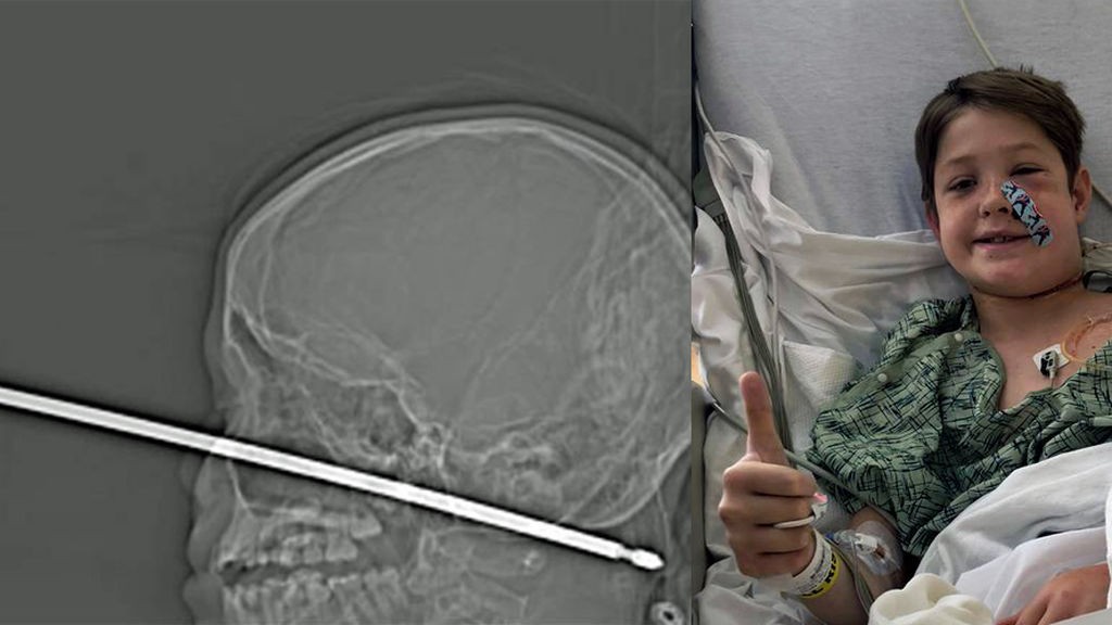 El milagro del nene que sobrevivió pese a clavarse una enorme aguja en la cabeza | Curiosidades