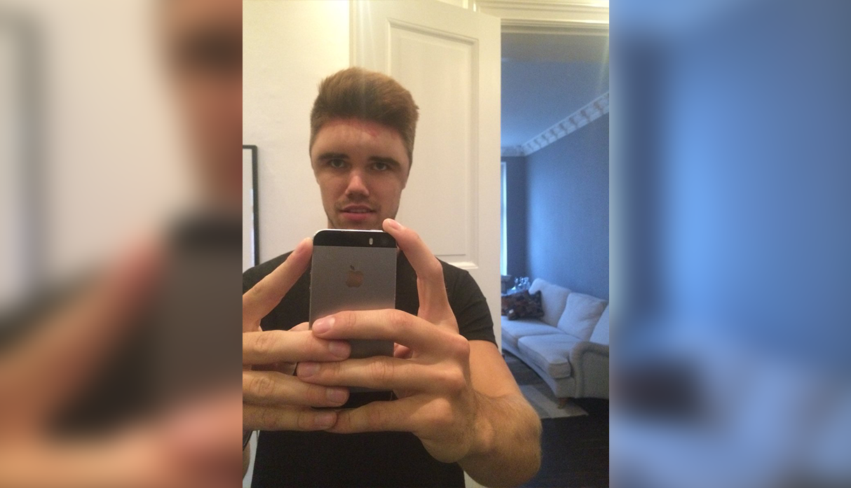 El terrible caso del joven que se tiñó el pelo y terminó con la cabeza hinchada | Redes