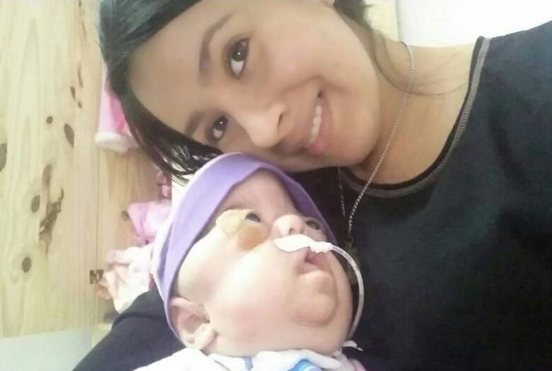Madre de la única beba argentina con síndrome de Beare-Stevenson : "Juliana me ha enseñado a vivir cada día" | Actualidad