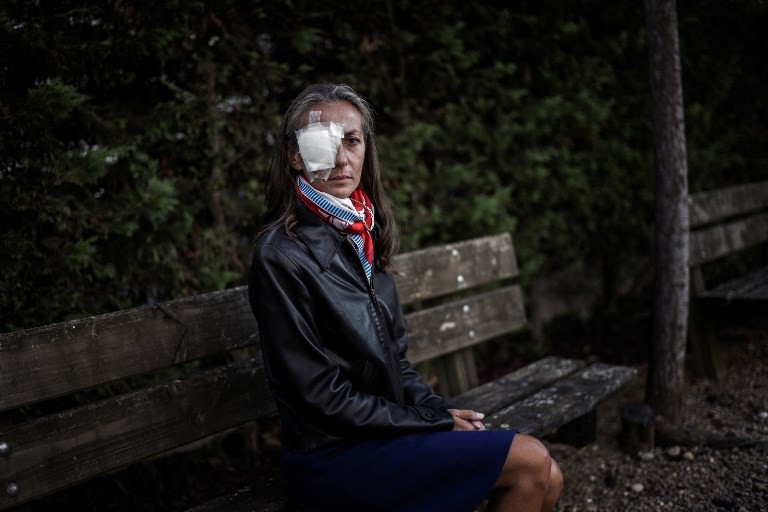 Perdió un ojo al recibir una bola lanzada por el golfista Brooks Koepka | Internacionales