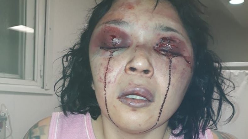 El fuerte relato de una mujer que fue brutalmente golpeada con un hierro por su expareja | Actualidad